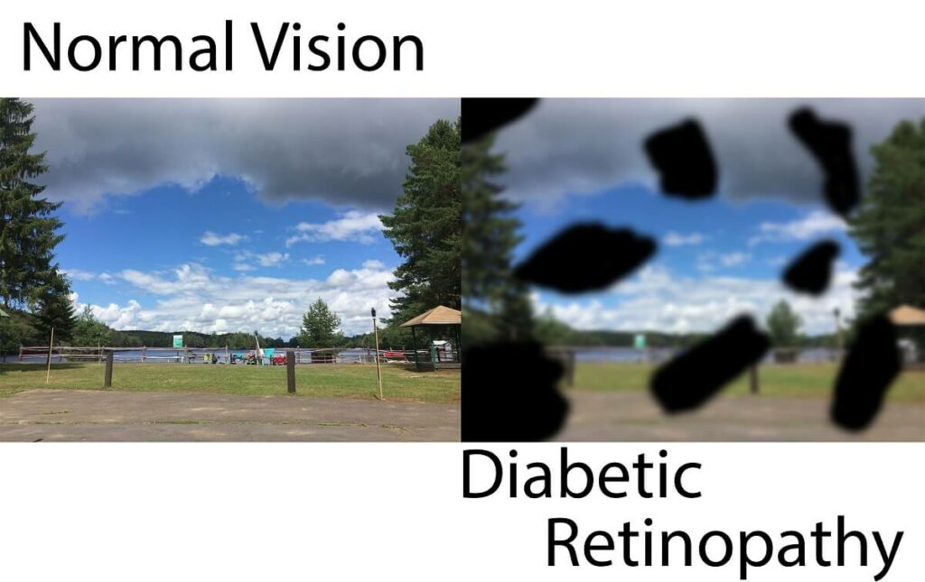 Two images intended to be identical as a side by side comparison of normal vision compared to the vision with diabetic retinopathy