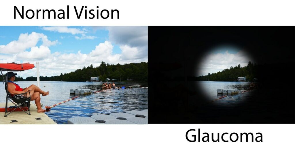 Two images intended to be identical as a side by side comparison of normal vision compared to the vision with glaucoma